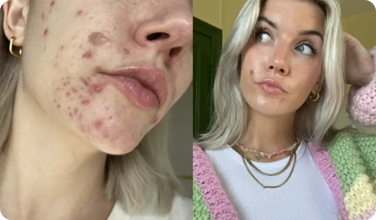 Anaïs avant et après 10 semaines de Clear+