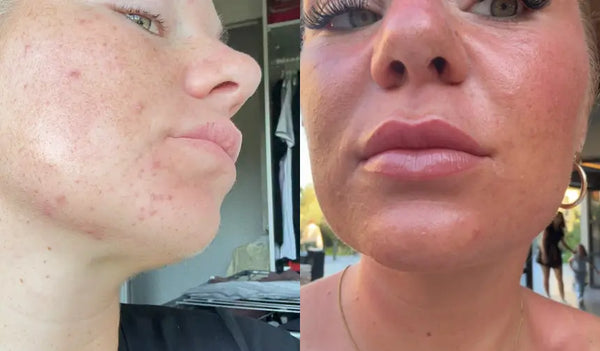 Mon menton est enfin calme