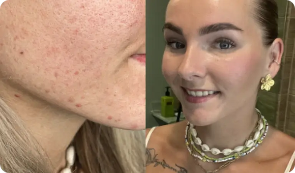 Les taches rouges disparaissent plus vite