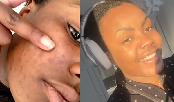 Ça a commencé avec moins de sébum