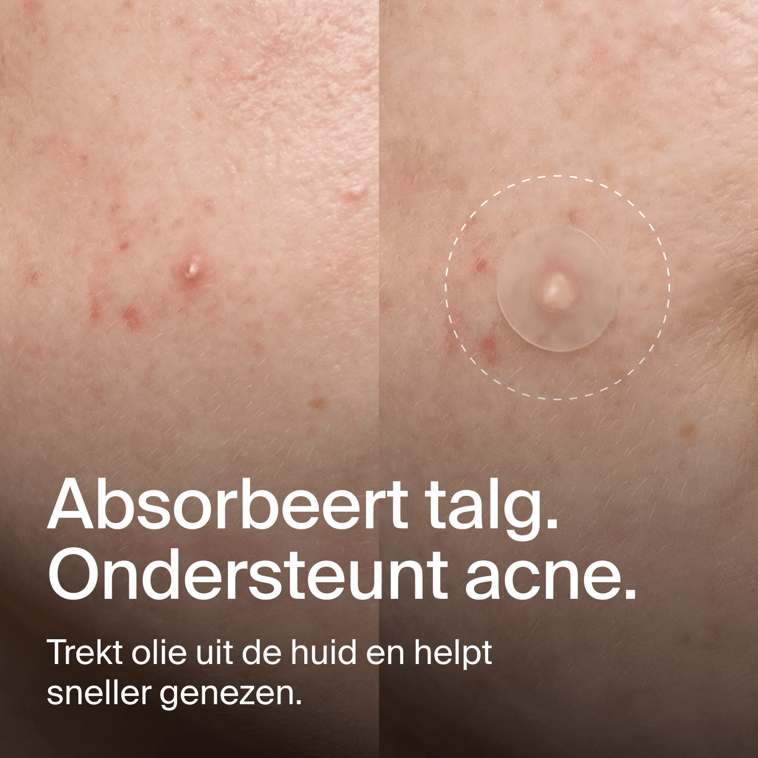 Clear Dots - Patchs Anti-Acné
