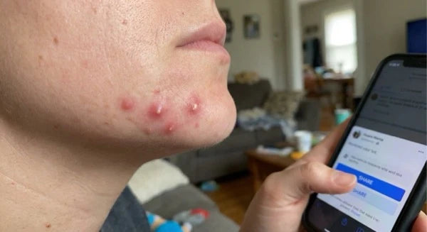 Boutons douloureux ou kystiques