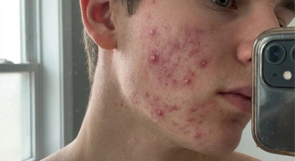 Rougeurs et inflammation